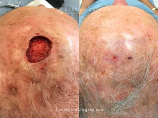 Mohs Surgery for Skin Cancer on the Scalp