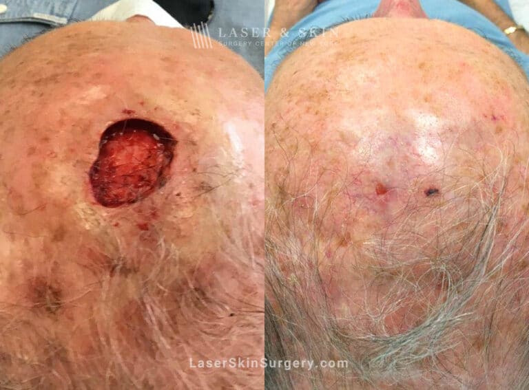 Mohs Surgery for Skin Cancer on the Scalp