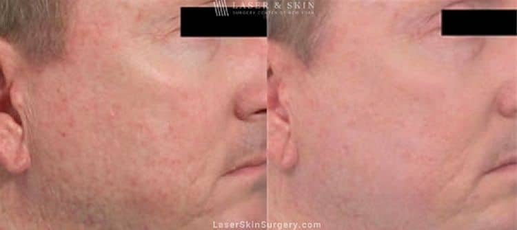 acne-scar-laser-treatment-results-new-york acne scar treatment before and after in new york