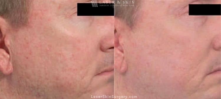 acne scar treatment before and after in new york