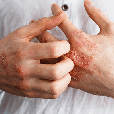 Eczema cosmetic dermatology consultation in new york