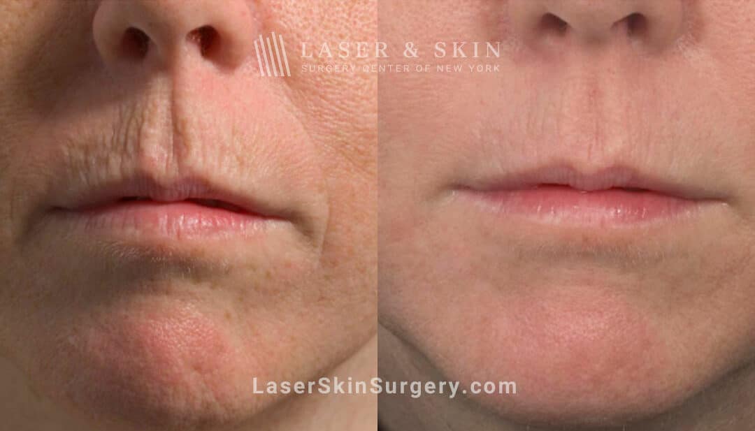 fractional resurfacing for wrinkles above lips