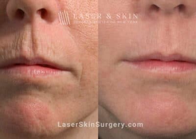 Fractional laser used to treat perioral lines and rejuvenate skin around the mouth