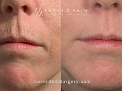 Fractional laser used to treat perioral lines and rejuvenate skin around the mouth