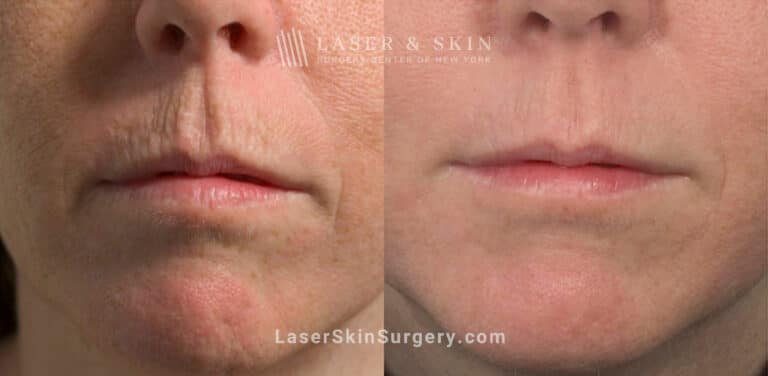 Fractional laser used to treat perioral lines and rejuvenate skin around the mouth