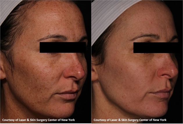 laser dermatology for anti-aging in new york