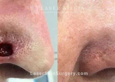 Mohs Micrographic Surgery to Treat Cancer on Nose