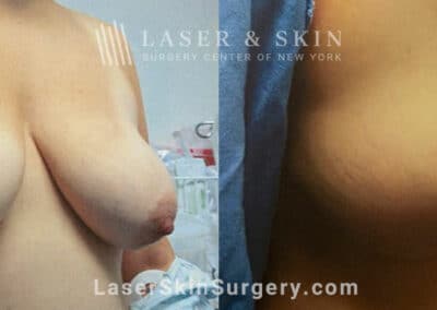 Breast Lift to Enhance Breast Shape