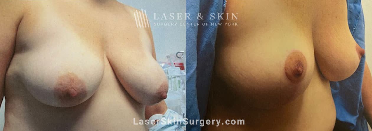 breast lift before and after