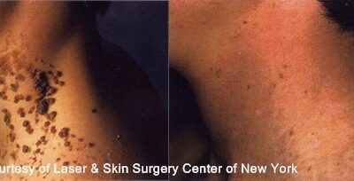 Laser Treatment for Epidermal Nevus