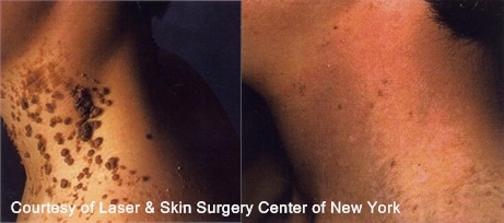 Laser Treatment for Epidermal Nevus