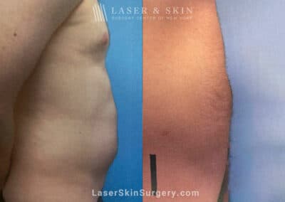 Liposuction to Remove Abdominal Fat