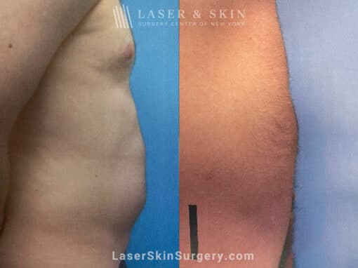 Liposuction to Remove Abdominal Fat