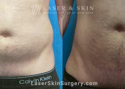 Liposuction to Remove Abdominal Fat