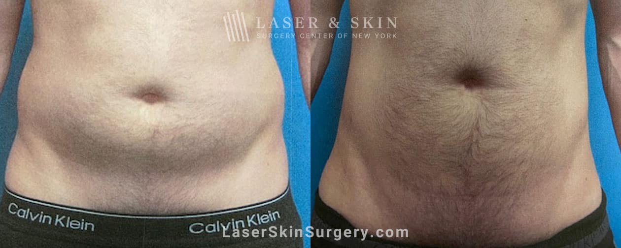 Liposuction-to-remove-abdominal-fat-Hoffman-NYC-front male liposuction in new york city