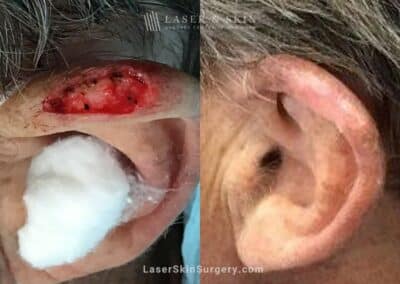 Mohs Micrographic Surgery to Treat Cancer on Ear