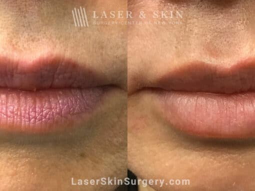 Juvederm Filler Injections for Lip Plumping