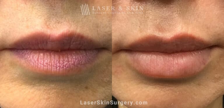 Juvederm Filler Injections for Lip Plumping