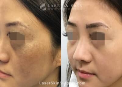 Picosecond laser to treat nevus of ota birthmark