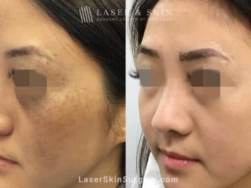 Picosecond laser to treat nevus of ota birthmark