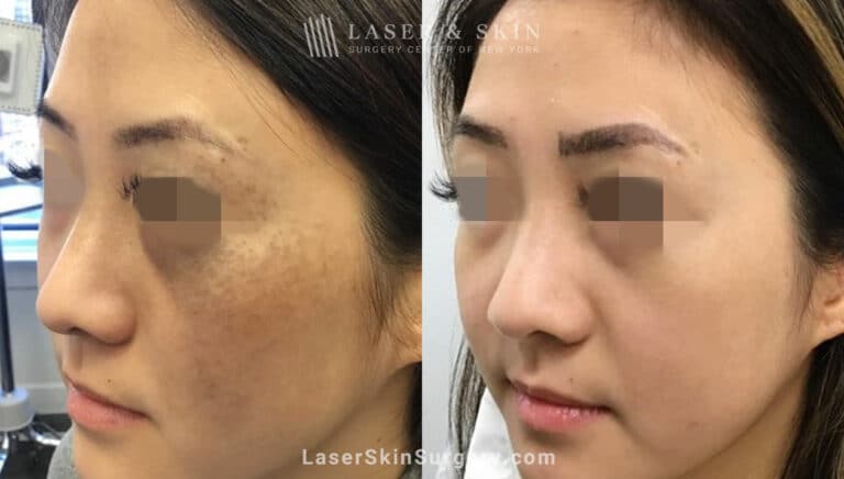 Picosecond laser to treat nevus of ota birthmark