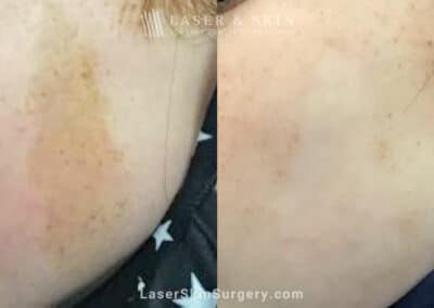 Ruby laser used to reduce the appearance of Café au Lait macules