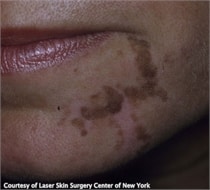 cafeaulait-NYC-NY Cafe Au Lait skin treatment NYC, NY
