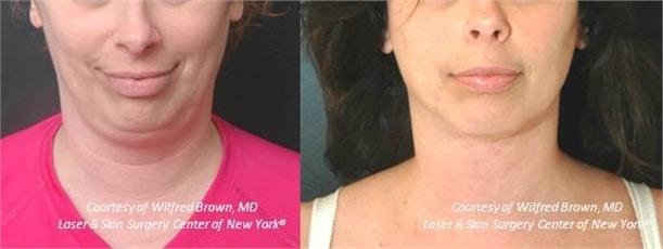 double-chin-treatment-new-york double chin treatment in new york