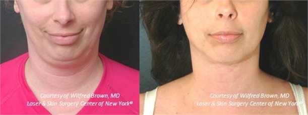 double chin treatment in new york