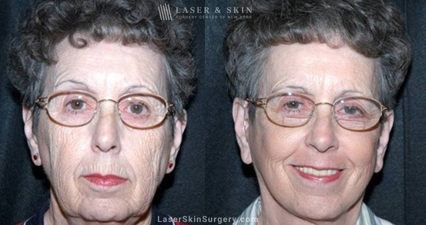 facial plastic surgery for wrinkles in new york