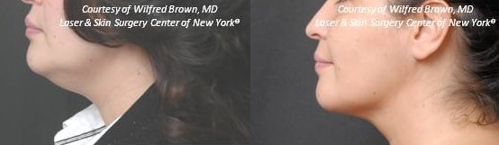 liposculpture double chin treatment in new york