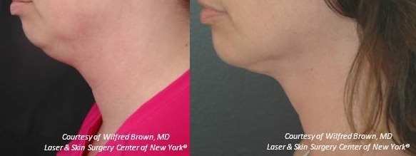 liposuction for double chin in new york