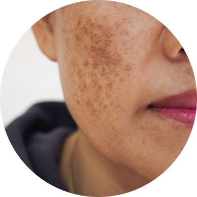 melasma-dark-skin-treatment-new-york melasma dermatology treatments in new york