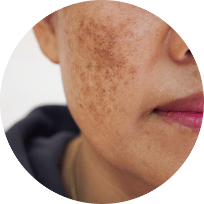 melasma dermatology treatments in new york