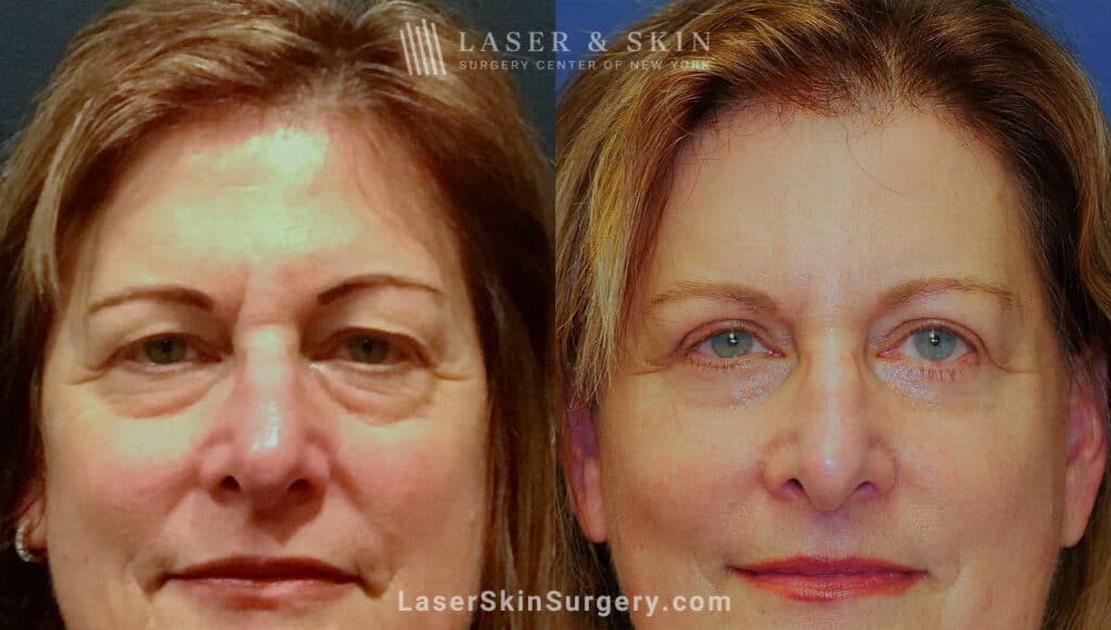 Wrinkles under eyes before and after deals
