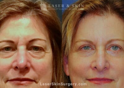 Blepharoplasty to Refresh Eyes