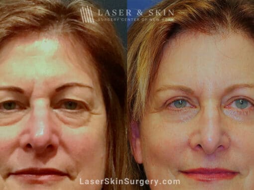 Blepharoplasty to Refresh Eyes