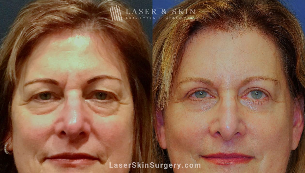 blepharoplasty results in nyc blepharoplasty results in nyc