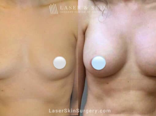 Breast Augmentation to Increase Breast Size