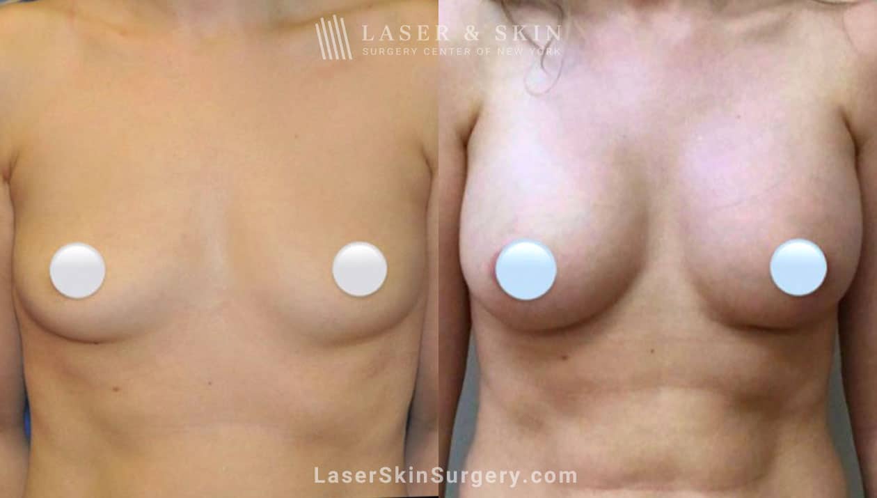 Breast augmentation is a cosmetic surgery procedure that involves the placement of silicone or saline implants to increase breast size, enhance breast shape, or improve natural breast size symmetry.