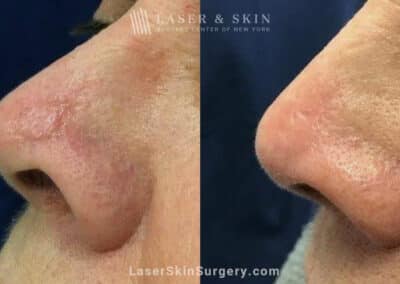 Fraxel Dual to Treat Scar on Nose