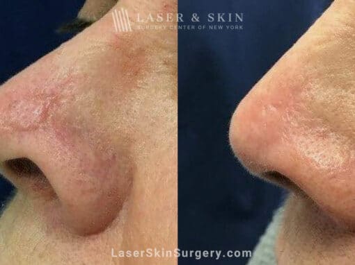 Fraxel Dual to Treat Scar on Nose