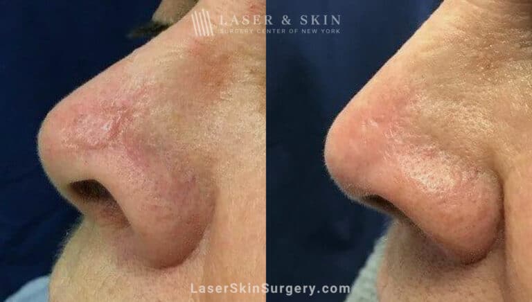Fraxel Dual to Treat Scar on Nose