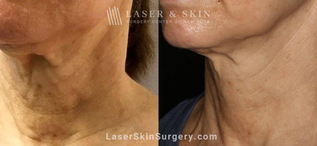 genius microneedling for neck rejuvenation before and after