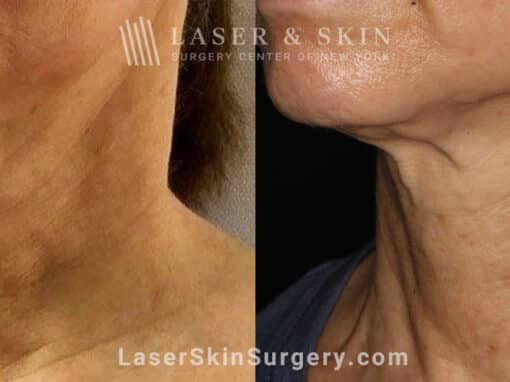 Genius microneedling to rejuvenate skin on the neck