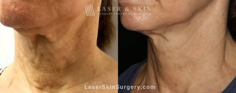 Genius microneedling to rejuvenate skin on the neck