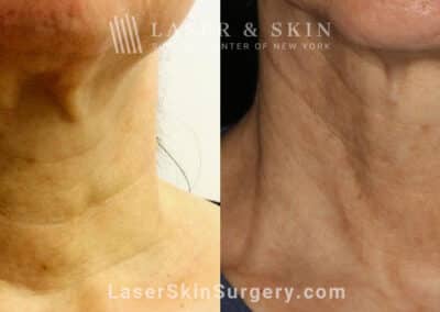Genius microneedling to rejuvenate skin on the neck