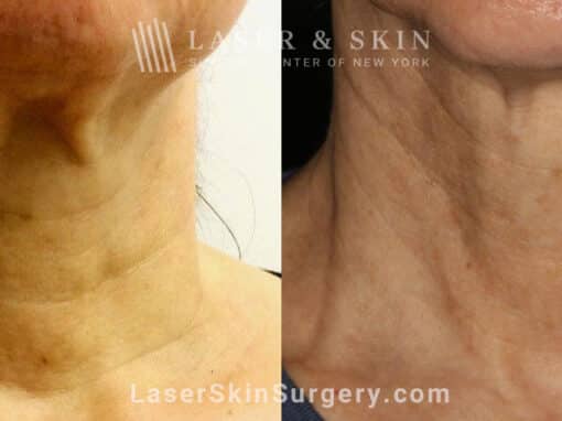 Genius microneedling to rejuvenate skin on the neck