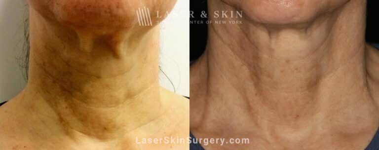 Genius microneedling to rejuvenate skin on the neck