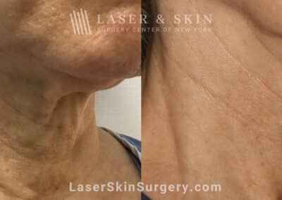 Genius microneedling to rejuvenate skin on the neck